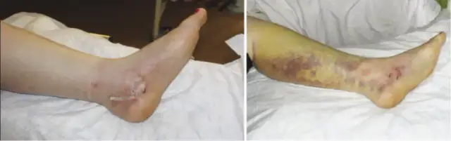 Jak wygląda ugryzienie węża? Objawy, które mogą cię zaskoczyć