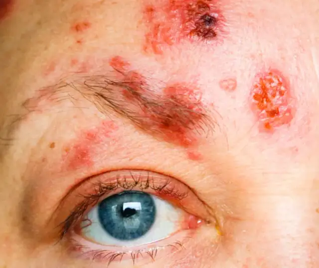 Jakie leki na półpasiec oczny są skuteczne i bezpieczne? Porady i leczenie