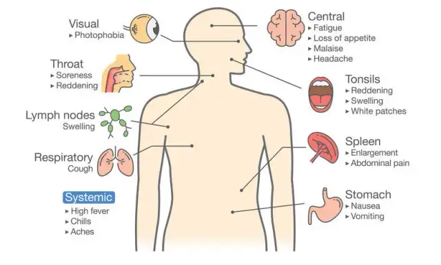 Síntoma de la mononucleosis: identifica los signos y evita complicaciones