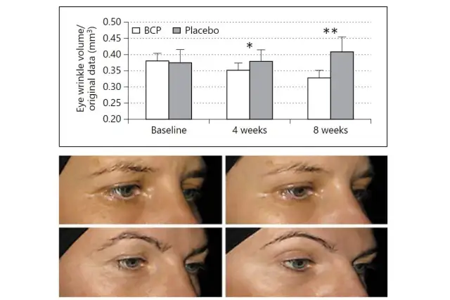 Porównanie efektów kolagenu: zdjęcia twarzy przed i po 4 i 8 tygodniach stosowania. Widać redukcję zmarszczek wokół oczu.