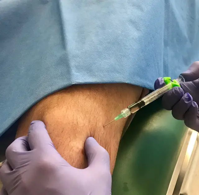 Jak długo boli kolano po kwasie hialuronowym? Poznaj prawdę o bólu