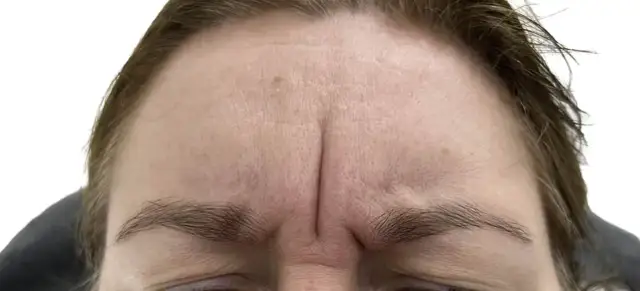 Gdzie kupić botox Allergan? Sprawdzone miejsca i ważne informacje