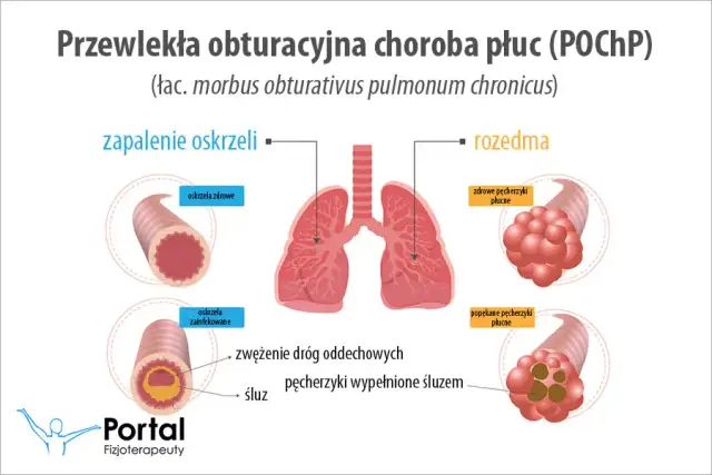 POChP a klimat: Gdzie szukać ulgi i jak oddychać lepiej?