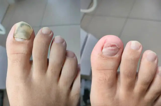 Jak długo boli zbity paznokieć? Sprawdź, co musisz wiedzieć