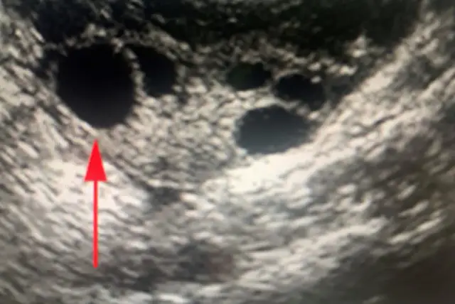 Czy na USG widać owulację? Pewne znaki na ekranie