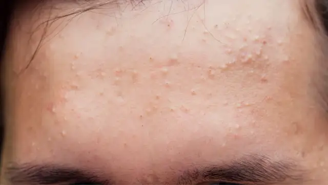 Domowe Sposoby na Pryszcze: Skuteczne Metody i Czego Unikać