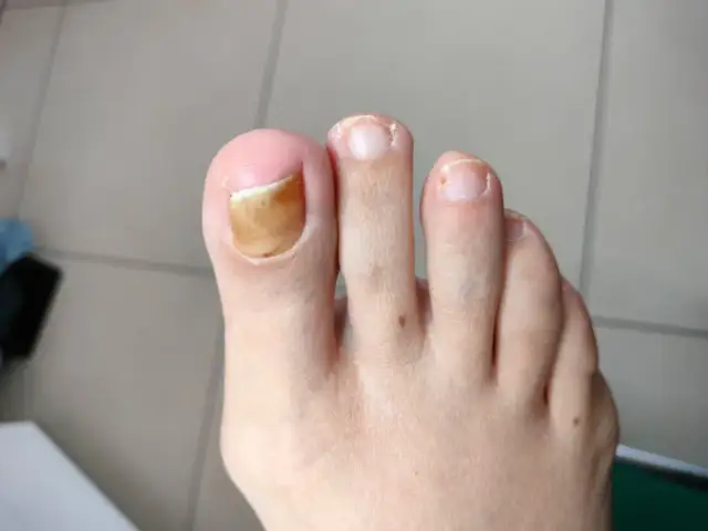 Skuteczne sposoby na pękające paznokcie u nóg - domowe kuracje