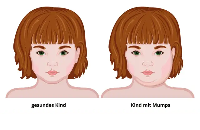 Mumps-Symptome: Erkennen, Verlauf & Komplikationen | Was tun?