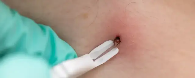 Objawy kleszcza u człowieka: borelioza, KZM kiedy do lekarza?