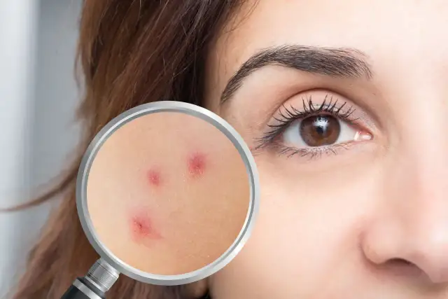 Powiększone zaczerwienienia na skórze, sugerujące problem z nużeńcem.