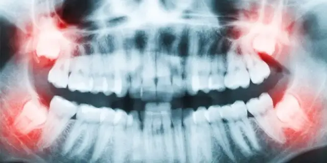 Który ząb to ósemka? Ból, objawy i kiedy usunąć ząb mądrości