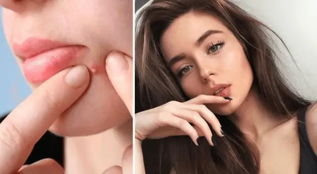 Skuteczne sposoby na pryszcze: jak szybko je wyleczyć i zapobiec