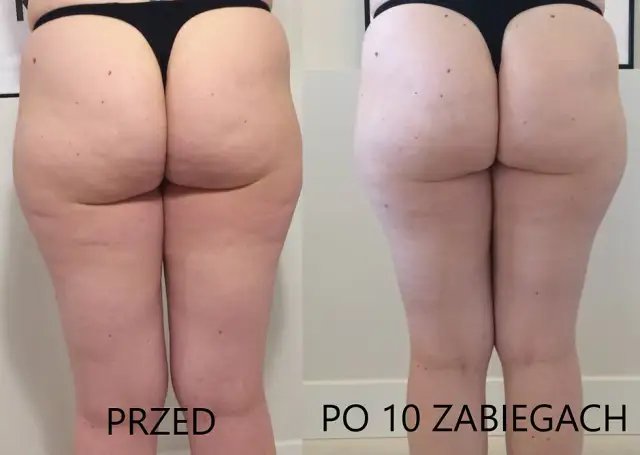 Masaż bańką chińską na cellulit: Instrukcja krok po kroku i efekty