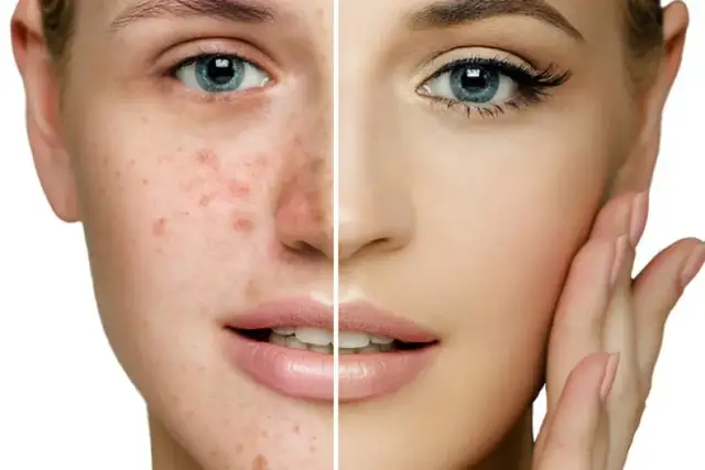 Jak mieć gładką cerę bez pryszczy - skuteczne sposoby na piękną skórę