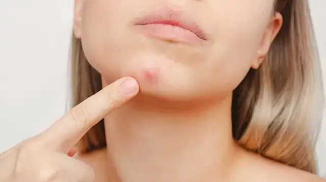 Jak pozbyć się pryszcza pod skórą? Skuteczne metody i porady