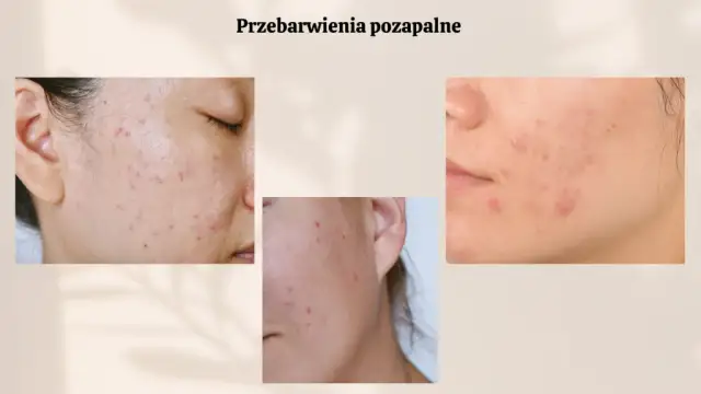 Czerwone plamy po pryszczach: Jak skutecznie pozbyć się PIE?