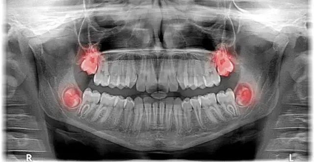 Czy ósemki rosną na górze? Odkryj prawdę o zębach mądrości
