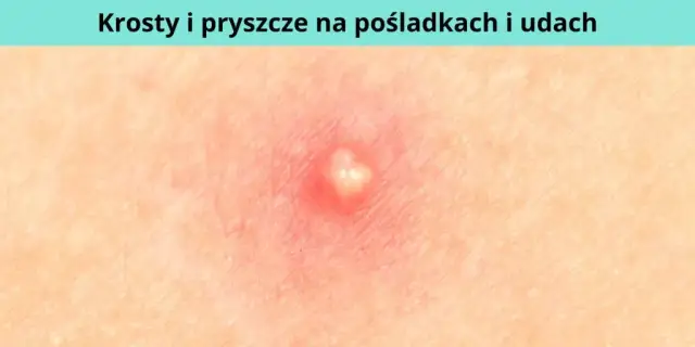 Co oznaczają pryszcze w poszczególnych miejscach i jak je leczyć