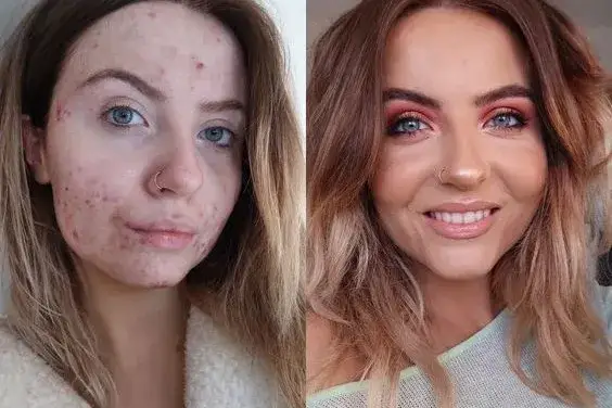 Jak poprawić stan cery trądzikowej - skuteczne metody na piękną skórę