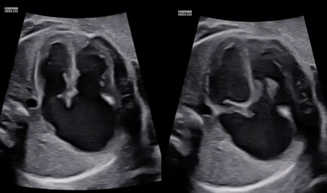 RTG w ciąży: Prześwietlenie płuc bezpieczne dla płodu? Poznaj fakty