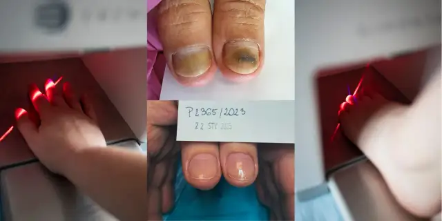 Grzybica paznokci: Od lakieru po laser co wyleczy ją na stałe?