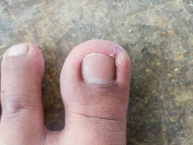 Jak wygląda wrośnięty paznokieć? Objawy i skutki, które musisz znać