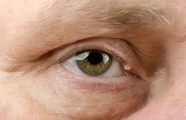 Czerwona plamka na oku – co oznacza i jak uniknąć poważnych problemów