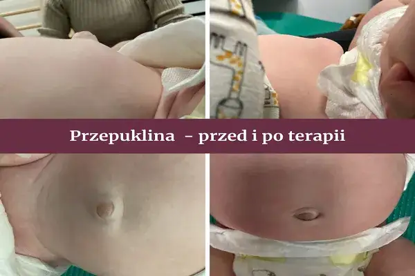 Objawy przepukliny pępkowej: Jak rozpoznać i kiedy działać?