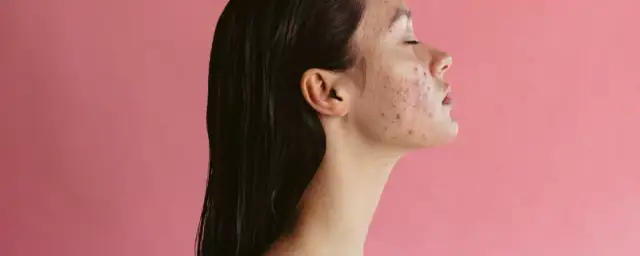 Jak pozbyć się blizn po pryszczach - skuteczne metody i porady