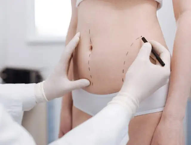 Lipoliza czy liposukcja – która metoda skuteczniej redukuje tłuszcz?