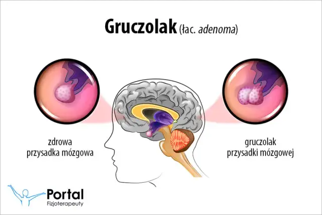 Gruczolak przysadki: objawy psychiczne. Czy to hormony?