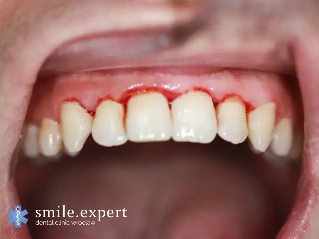 Jak leczyć stan zapalny dziąseł? Domowe sposoby i dentysta