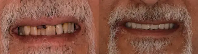 Nowe zęby: Ile kosztują? Pełny cennik i finansowanie w Polsce