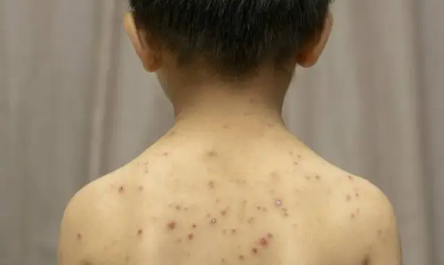 Czy dziecko ze strupami po ospie może iść do przedszkola? Ważne zasady i zalecenia