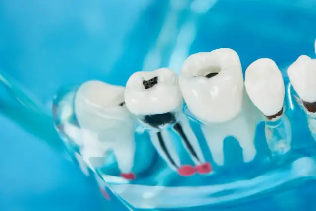 Model szczęki z widoczną próchnicą przy dziąśle. Ciemne ubytki w zębach, widoczne korzenie.