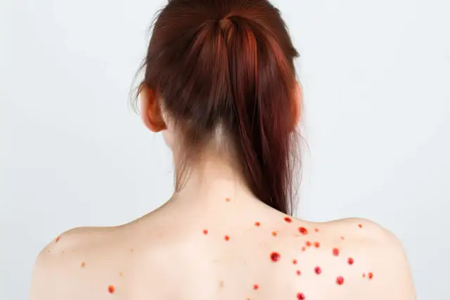 Jak szybko pozbyć się strupa po pryszczu? Gojenie bez blizn!