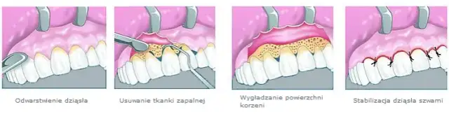 Ile trwa zdjęcie szwów z dziąsła? Szybki i bezbolesny proces