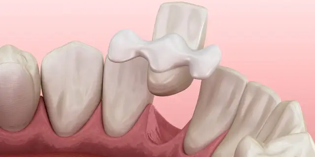 Mostek na zębach: Jak wygląda? Czy jest niewidoczny?