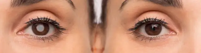 Objawy zaćmy korowej - jak je rozpoznać i uniknąć pogorszenia wzroku