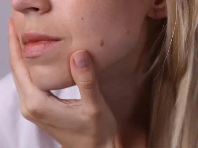 Skąd się biorą pieprzyki? Odkryj przyczyny i zagrożenia zdrowotne