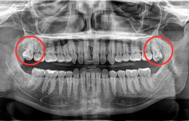Ile rośnie ząb mądrości? Etapy, objawy i jak uniknąć bólu