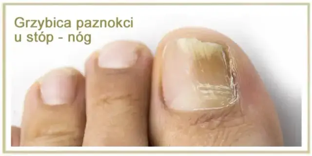 Jak skutecznie zapobiec grzybicy – praktyczne porady i sprawdzone metody