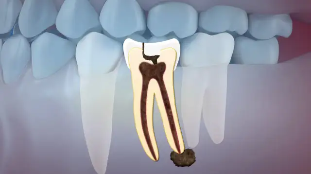 Ból po wyrwaniu zęba: Kiedy martwić się, a kiedy to norma?