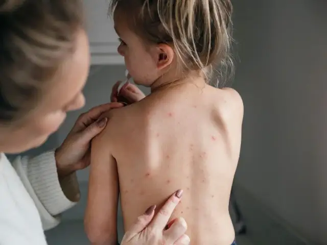 Co na ospę u dziecka - skuteczne metody łagodzenia objawów
