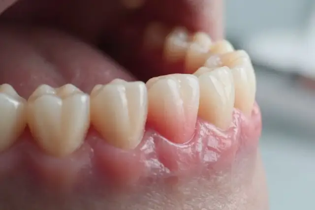 Spuchnięte dziąsło: Skuteczne sposoby na ból i kiedy iść do dentysty