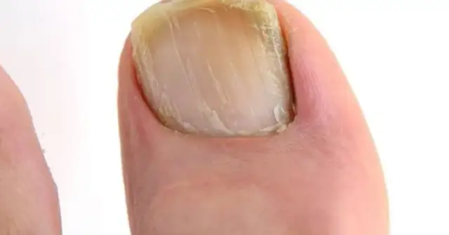 Skuteczne leczenie grzybicy paznokci: Co działa naprawdę?