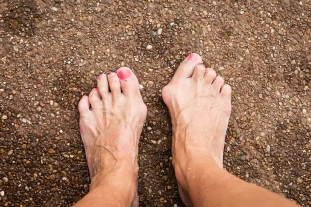 Jak wyglądają haluksy? Rozpoznaj objawy i znajdź ulgę!