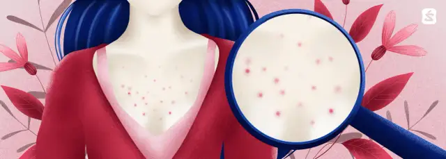 Skuteczne sposoby na to, jak pozbyć się pryszczy na dekolcie