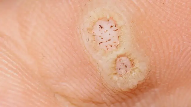 Brodacid bez recepty: Jak bezpiecznie i skutecznie pozbyć się kurzajek?