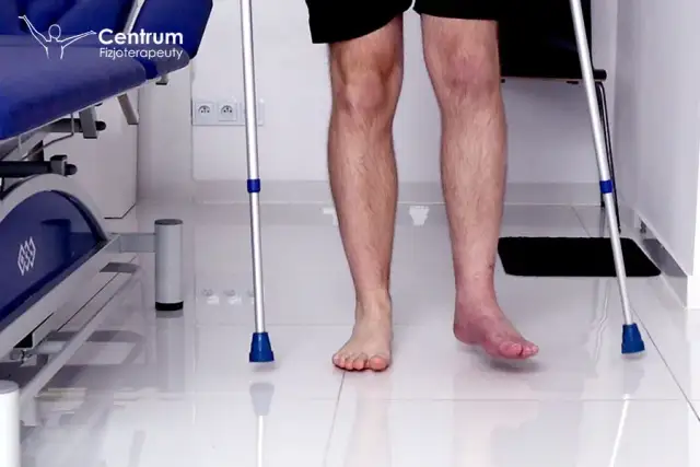 Złamana kostka: Pełny harmonogram rehabilitacji wracaj do formy!